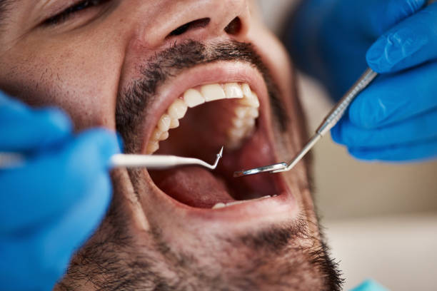 Best Dentist for Tooth Abscess  in Hanover, IN