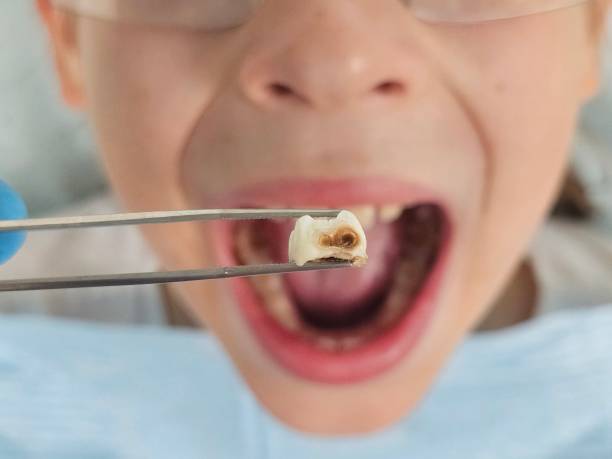 Best Teeth Whitening  in Hanover, IN